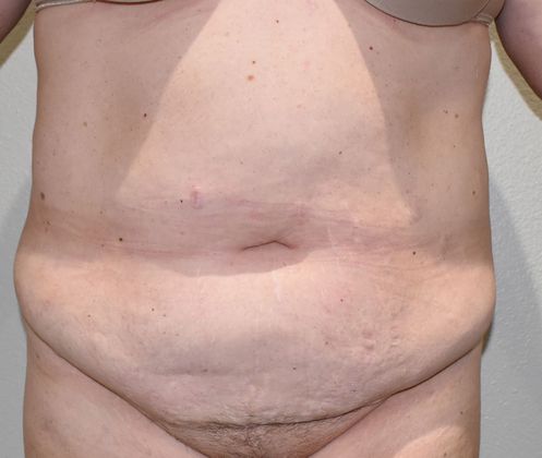 Tummy Tuck (Abdominoplasty): Case 221 - Before