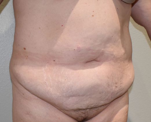 Tummy Tuck (Abdominoplasty): Case 221 - Before