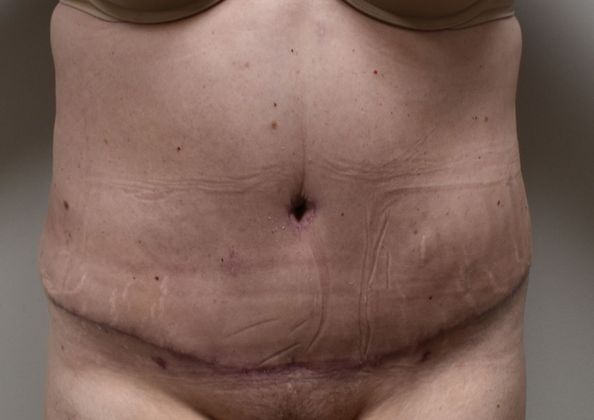 Tummy Tuck (Abdominoplasty): Case 221 - After