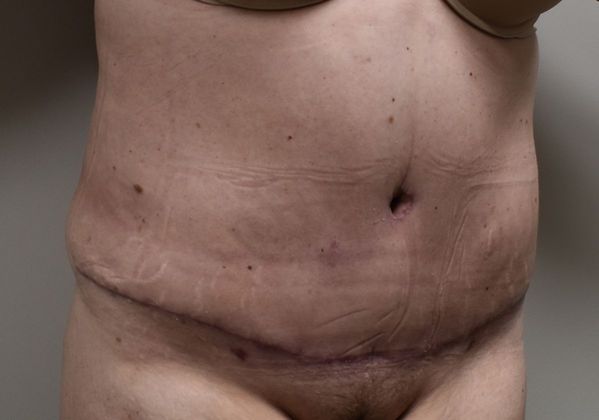 Tummy Tuck (Abdominoplasty): Case 221 - After