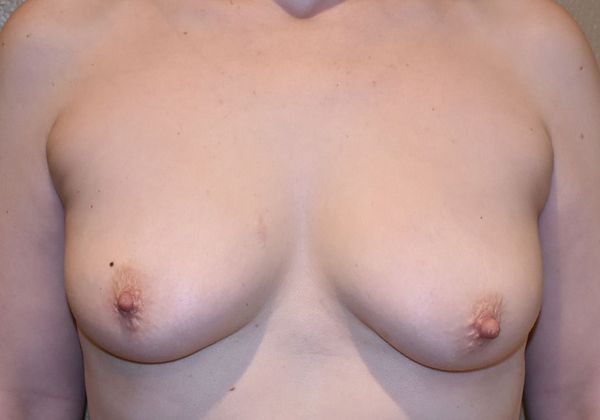 Breast Augmentation w/ Lift: Case 309 - Before