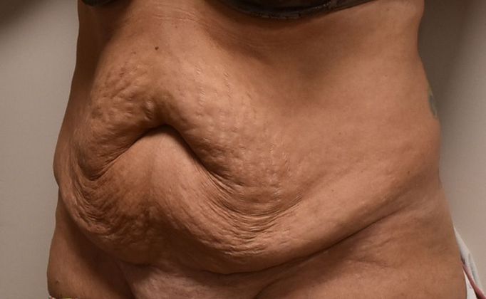 Tummy Tuck (Abdominoplasty): Case 222 - Before