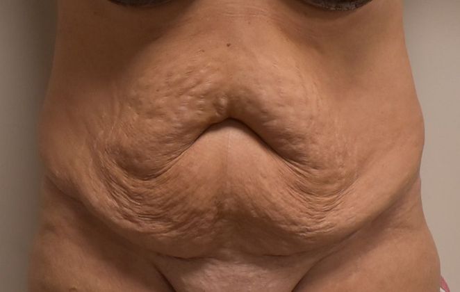 Tummy Tuck (Abdominoplasty): Case 222 - Before