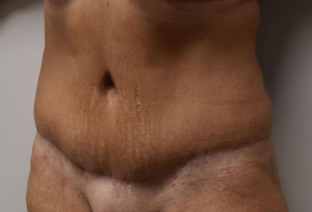 Tummy Tuck (Abdominoplasty): Case 222 - After