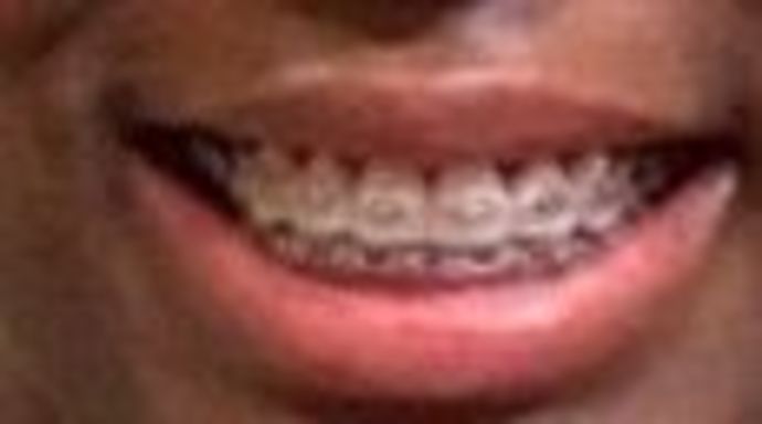 Gingivectomy : Upper Arch Gingivectomy - After