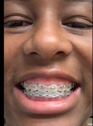 Gingivectomy  Upper Arch Gingivectomy - Before