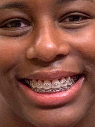 Gingivectomy  Upper Arch Gingivectomy - After