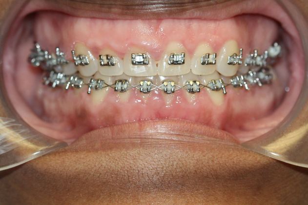 Gingivectomy  Laser Gingivectomy - Before