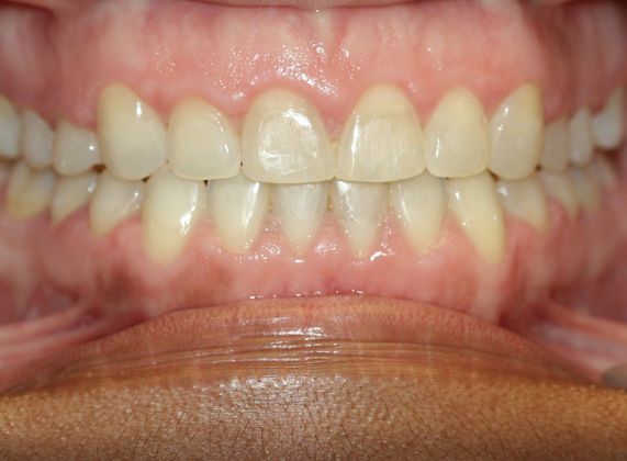 Gingivectomy  Laser Gingivectomy - After