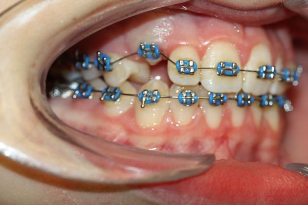 Gingivectomy  Laser Exposure   - After