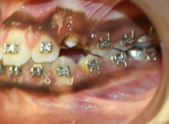 Gingivectomy : Canine Exposure - After