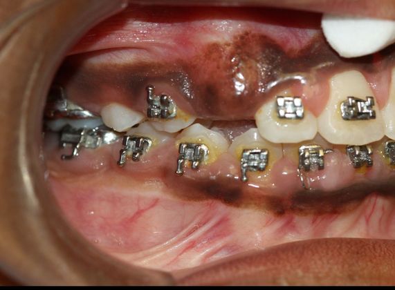 Gingivectomy : Canine Exposure - Before