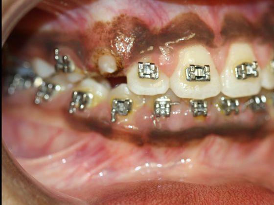 Gingivectomy : Canine Exposure - After