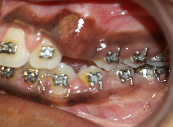 Gingivectomy : Canine Exposure - Before