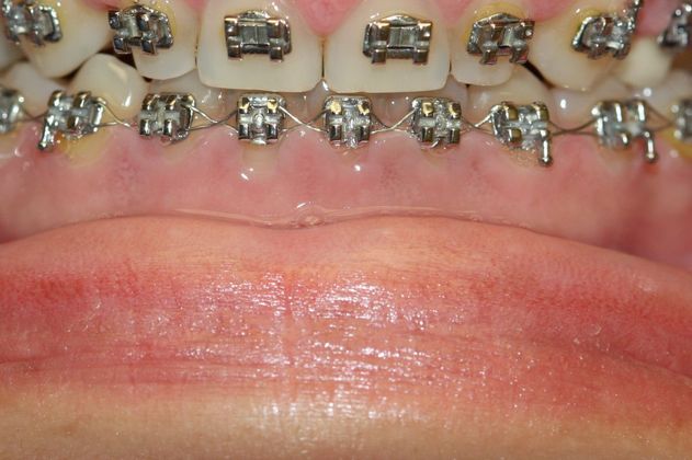 Gingivectomy  Lower Arch Gingivectomy  - Before