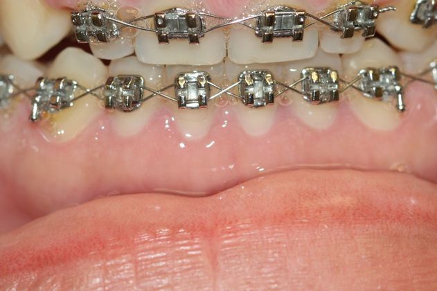 Gingivectomy  Lower Arch Gingivectomy  - After