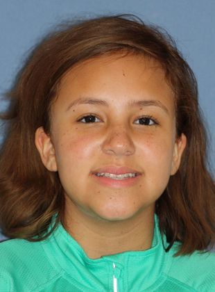 Crowding or Crooked Teeth: Narrow Upper Arch - Before