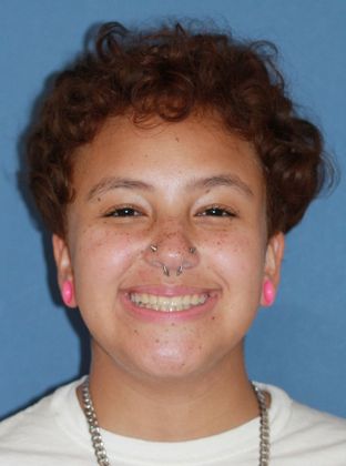 Crowding or Crooked Teeth: Narrow Upper Arch - After