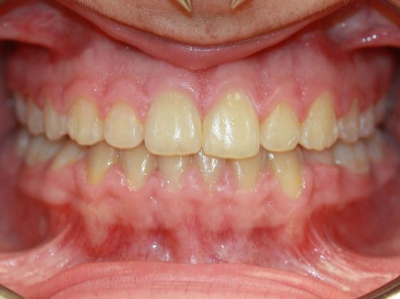  Crowding or Crooked Teeth Narrow Upper Arch - After