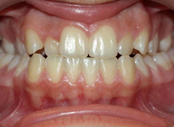  Crowding or Crooked Teeth Narrow Upper Arch - Before