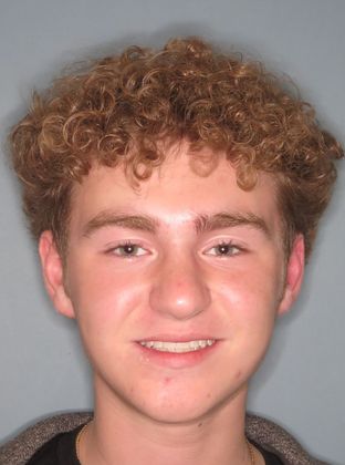  Crowding or Crooked Teeth Edge to Edge - After