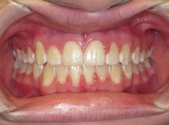 Crowding or Crooked Teeth: Edge to Edge - Before