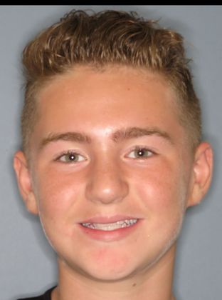  Crowding or Crooked Teeth Edge to Edge - Before