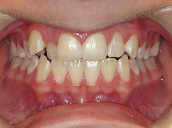 Crowding or Crooked Teeth: Edge to Edge - After