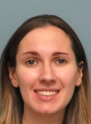 Crowding or Crooked Teeth: Anterior Crowding - After