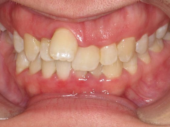  Crowding or Crooked Teeth Anterior Crowding - Before