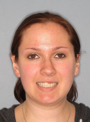 Crowding or Crooked Teeth: Anterior Crowding - Before