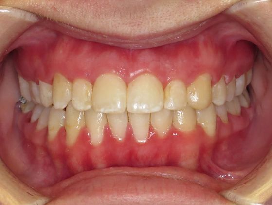  Crowding or Crooked Teeth Anterior Crowding - After