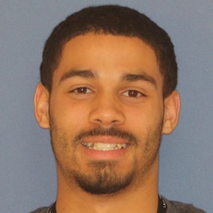  Crowding or Crooked Teeth Narrow Arches - Before