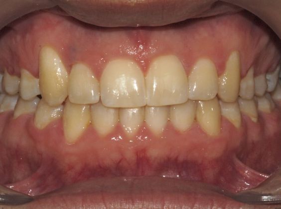 Crowding or Crooked Teeth: Narrow Arches - After