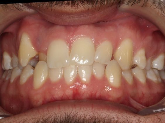 Crowding or Crooked Teeth: Narrow Arches - Before