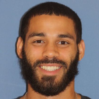  Crowding or Crooked Teeth Narrow Arches - After