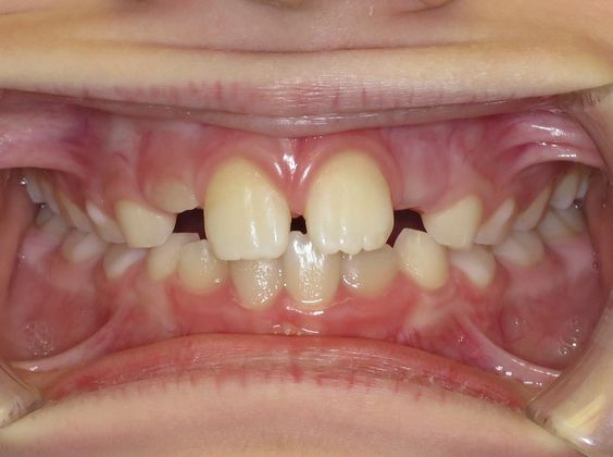 Children Smiles: Spaces - Before