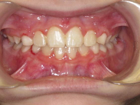 Children Smiles: Spaces - After