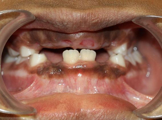 Children Smiles: Delay Eruption - Before