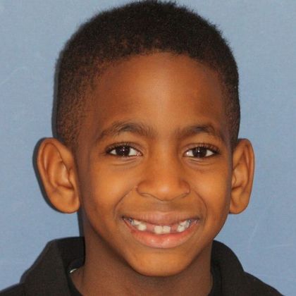 Children Smiles Delay Eruption - Before