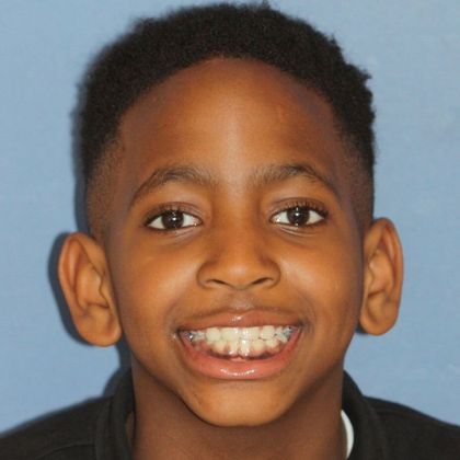 Children Smiles Delay Eruption - After