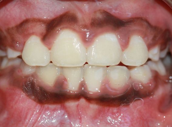 Children Smiles: Delay Eruption - After