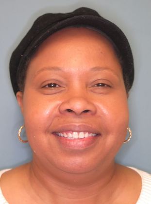 Tooth Spacing: Front Teeth Space - After