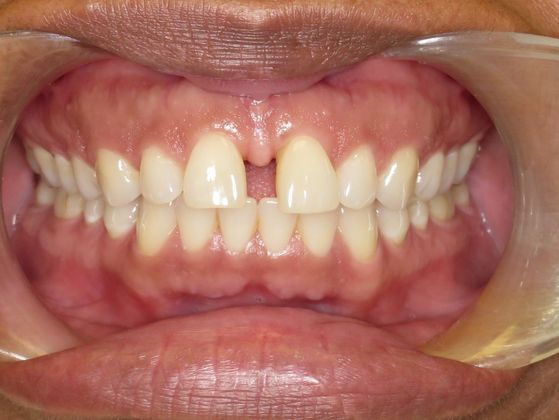 Tooth Spacing Front Teeth Space - Before