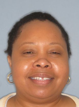 Tooth Spacing: Front Teeth Space - Before