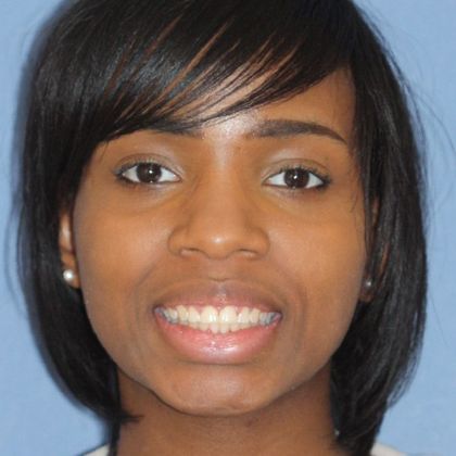 Tooth Spacing Space and Deep Bite  - After