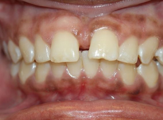 Tooth Spacing: Space and Deep Bite - Before