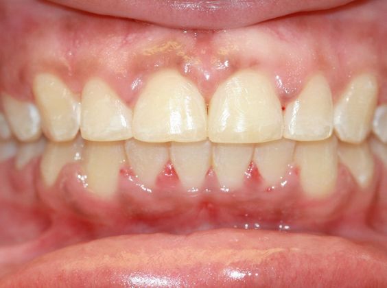 Tooth Spacing: Space and Deep Bite - After