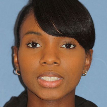 Tooth Spacing Space and Deep Bite  - Before