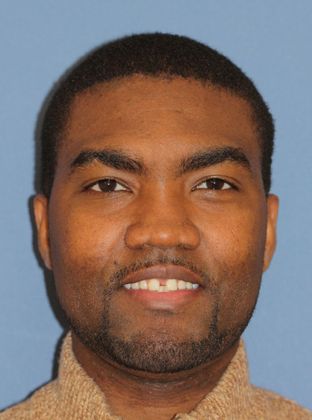 Tooth Spacing: Large Space - Before